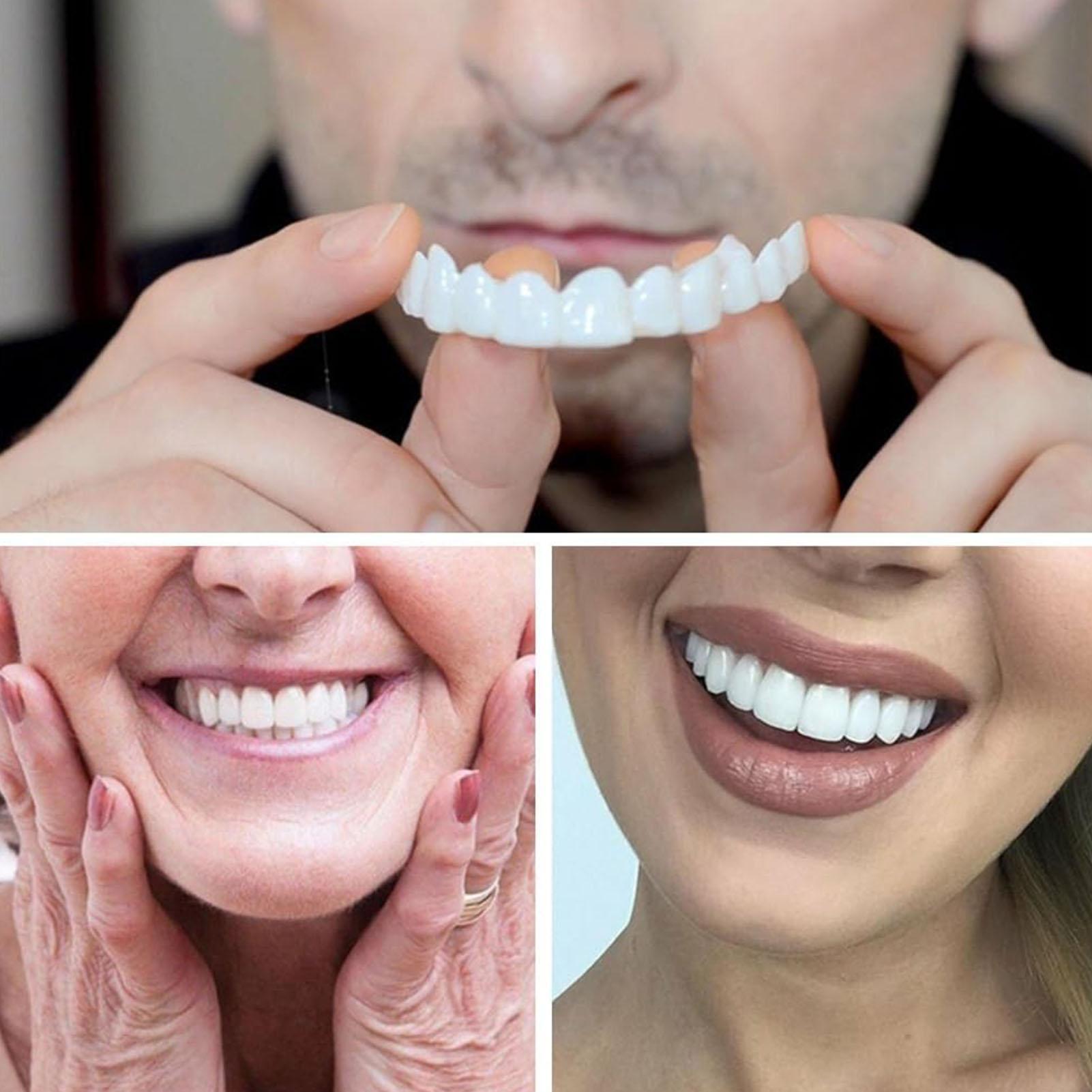 Kit Gigi Snap-on Veneer, Gigi  - Teeth Whitening In Office ulasan dan harga