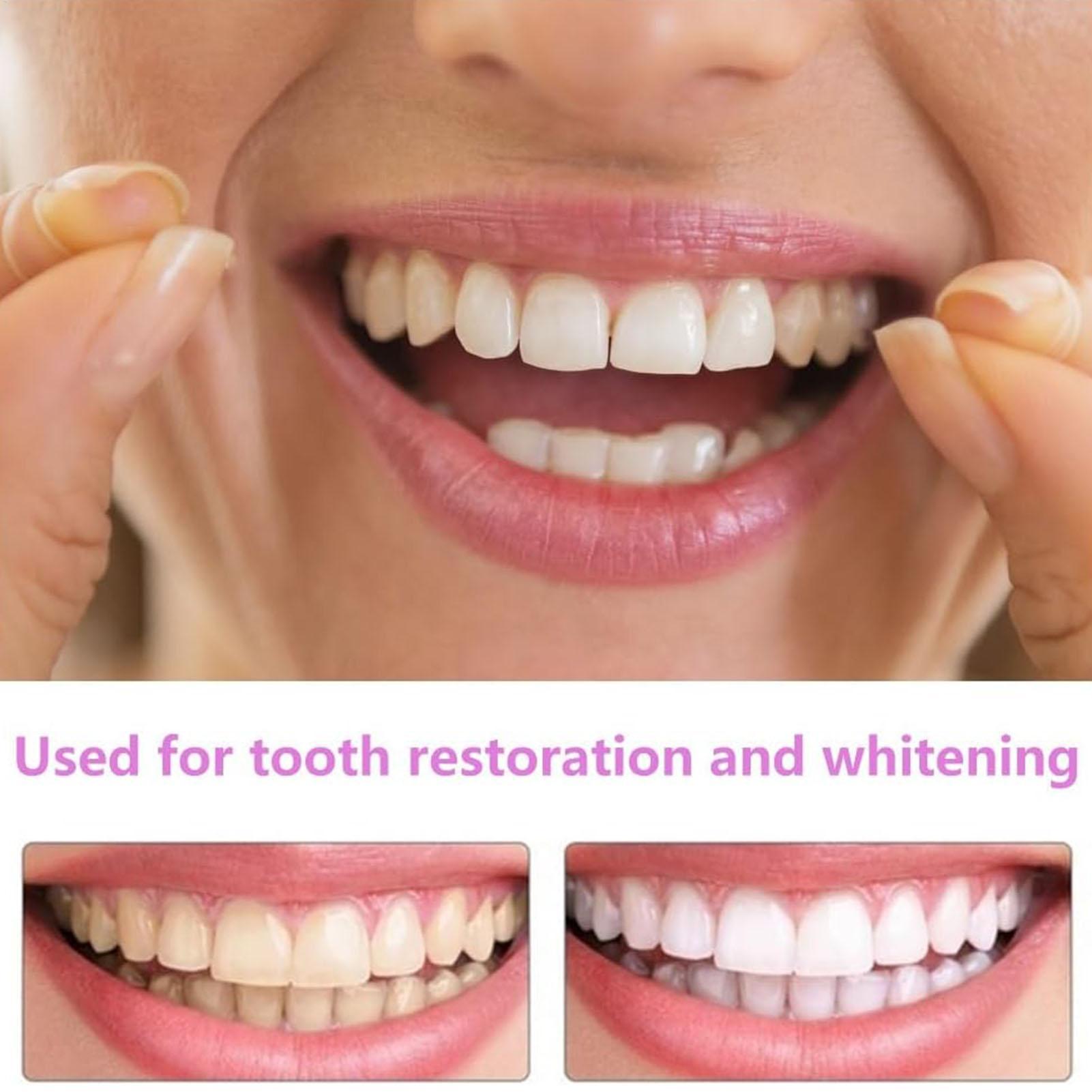 Kit Gigi Snap-on Veneer, Gigi  - Teeth Whitening In Office ulasan dan harga