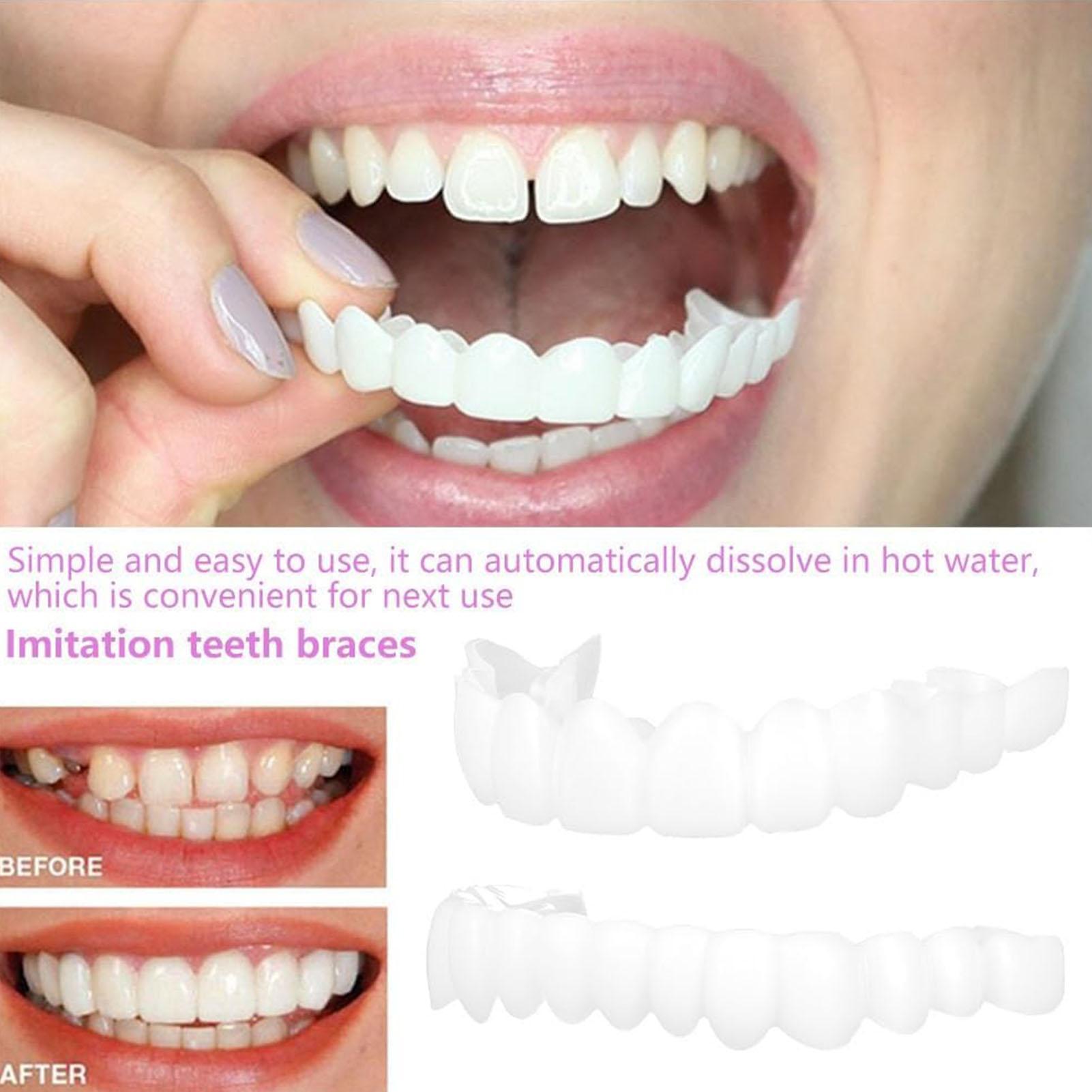 Kit Gigi Snap-on Veneer, Gigi  - Teeth Whitening In Office ulasan dan harga