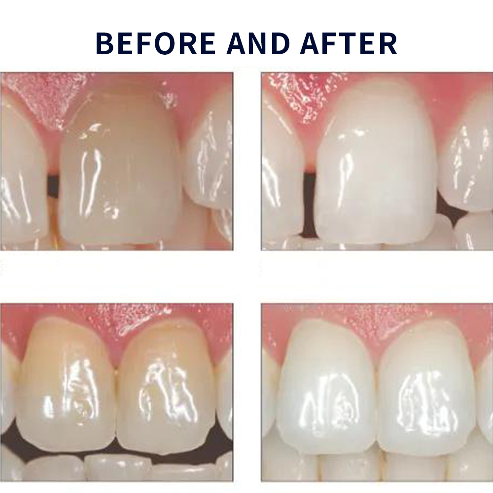 Opalescence Whitening 20% PF 2 - Teeth Whitening Near Me ulasan dan harga