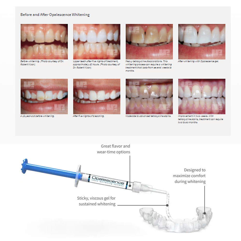 Opalescence Whitening 20% PF 2 - Teeth Whitening Near Me ulasan dan harga