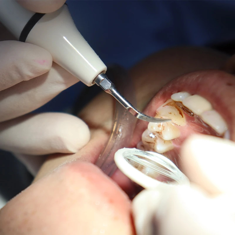 Scaler Handpiece Tabung Kabel  - Teeth Whitening Youtube ulasan dan harga
