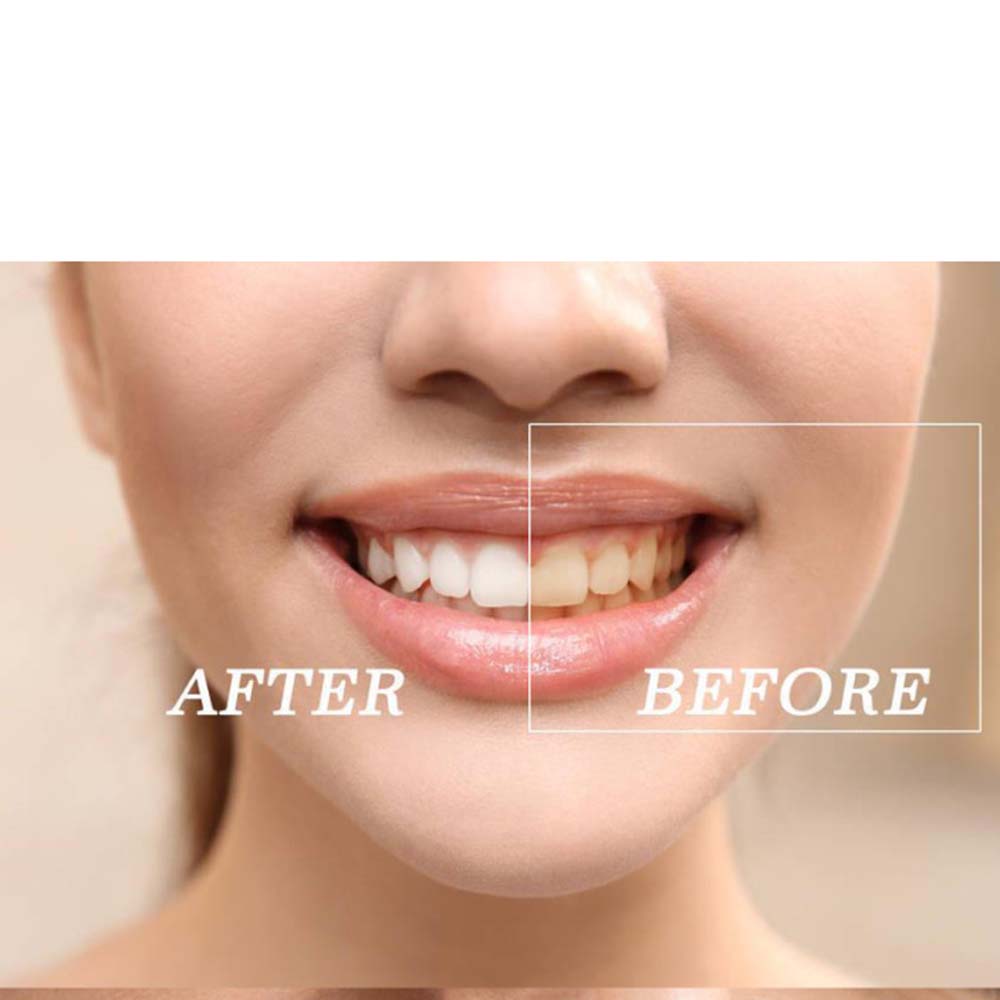 Kit Gel pemutih gigi peroksida - Teeth Whitening Kit ulasan dan harga